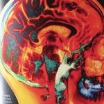 Die Magnetresonanztomographie (MRT) ist ein bildgebendes Verfahren, das hochauflösende Bilder von Gehirnstrukturen liefert.</br>In neuesten Untersuchungen konnten Effekte einer Psychotherapie mit bildgebenden Verfahren nachgewiesen werden